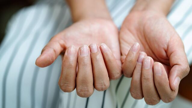 <p>I keep my nails short, which helps, but they still chip. I make sure to eat plenty of calcium in my diet — milk, yoghurt and cheese. Is there a supplement you could recommend?</p>